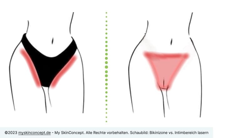 Unterschied Bikinizone lasern vs. Intimbereich lasern